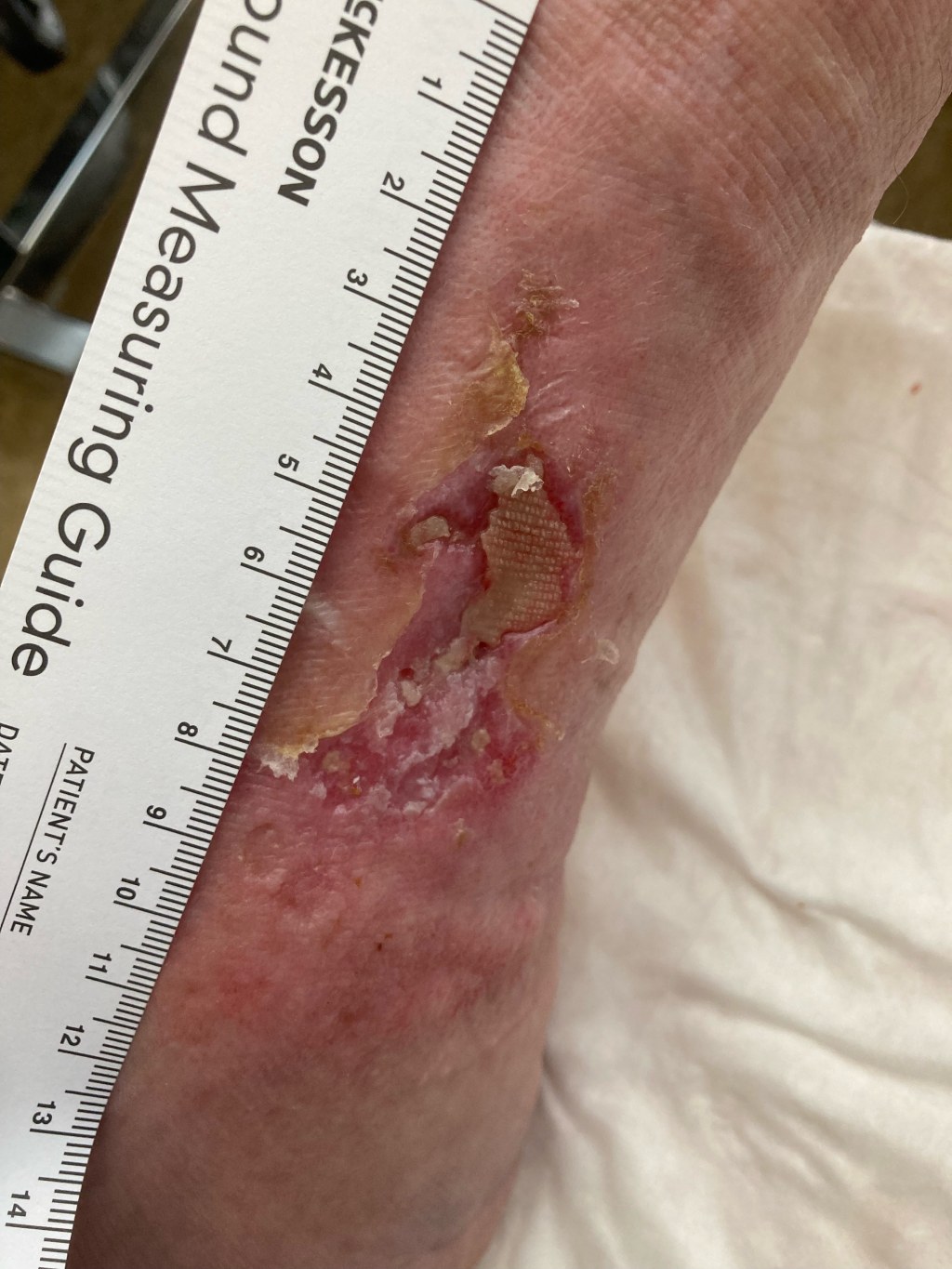 softkcot case1 before